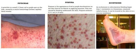 Petechiae are tiny, circular, nonraised patches that occur due to <b>bleeding</b> <b>under</b> <b>the skin</b>. . Pictures of bleeding under the skin